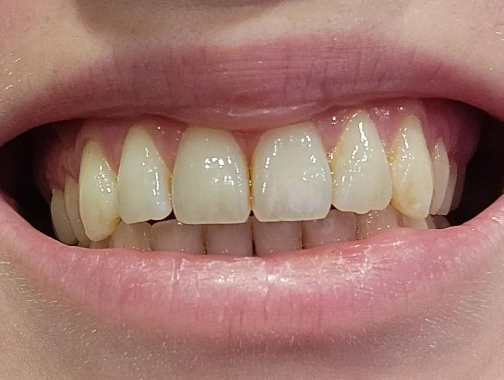 Weak Enamel Protection - Reduce Acid Exposure and Sugar