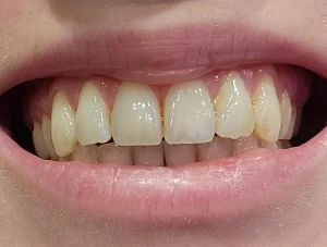 Weak Enamel Protection - Reduce Acid Exposure and Sugar