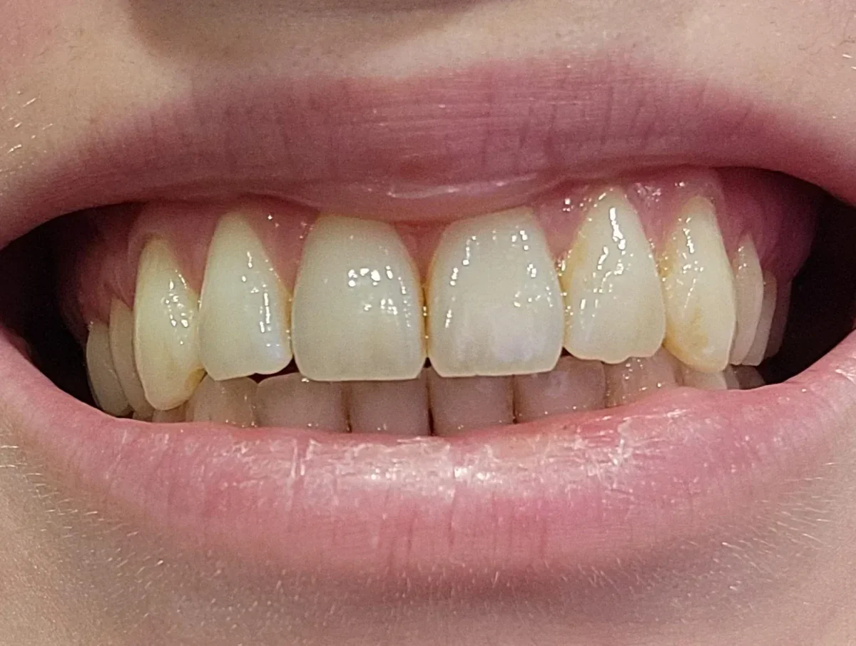 Weak Enamel Protection - Reduce Acid Exposure and Sugar